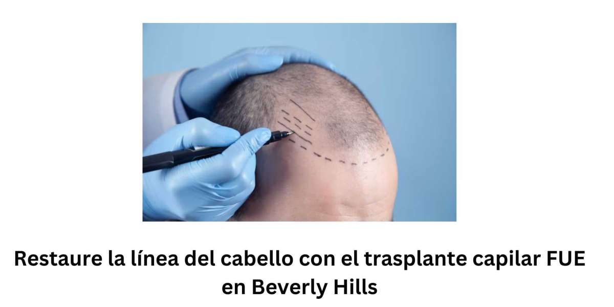 Restaure la línea del cabello con el trasplante capilar FUE en Beverly Hills