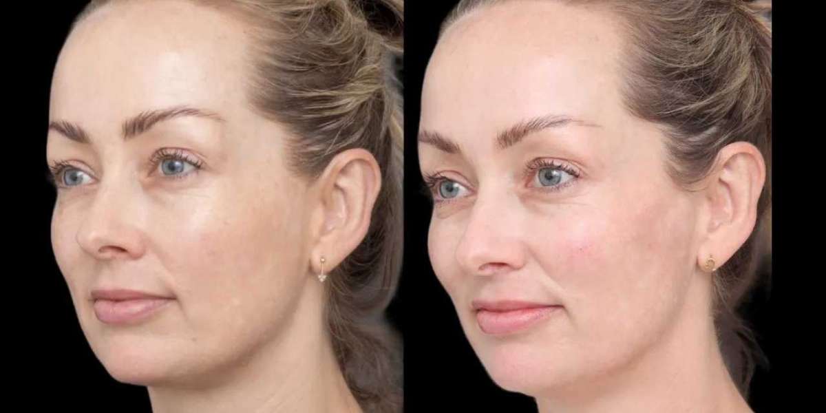 Budget-Friendly Cheek Fillers in Dubai: Affordable with Natural Results