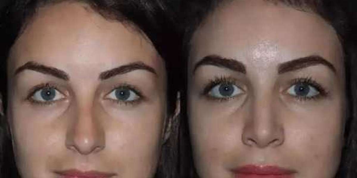 Best Doctors in Dubai for Exceptional Rhinoplasty Care and Results