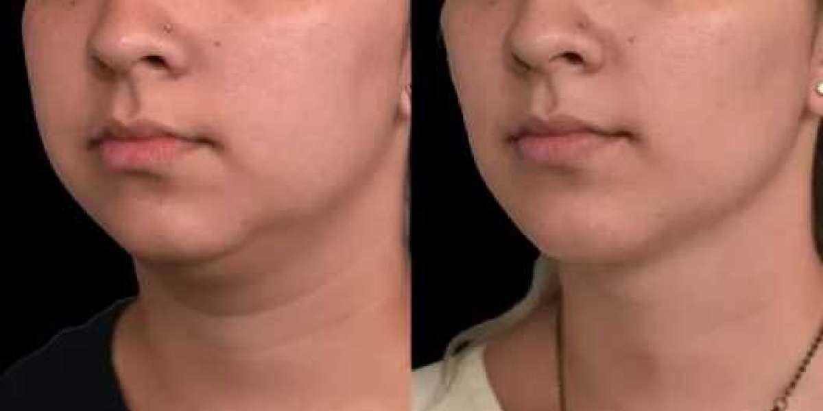 Best Double chin removal Surgeons in dubai Success Stories