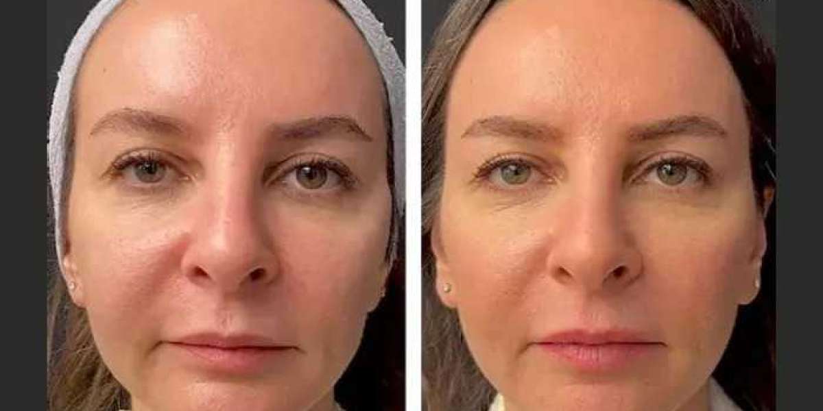 Best Doctors in Dubai Share the Top Benefits of Mesotherapy