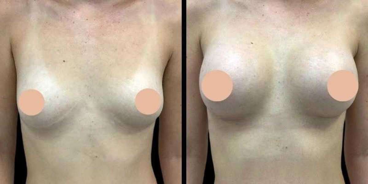 Why Consultation Is Important for Breast Augmentation in Dubai