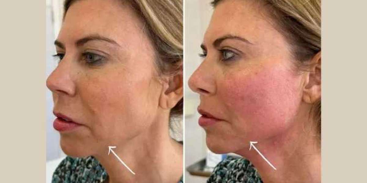 Best Doctors in dubai Transforming Facial Rejuvenation with Endolift
