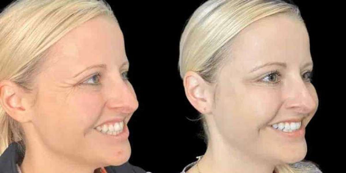 Best Aesthetic Clinic in Dubai for Botox with Trusted Cosmetic Excellence