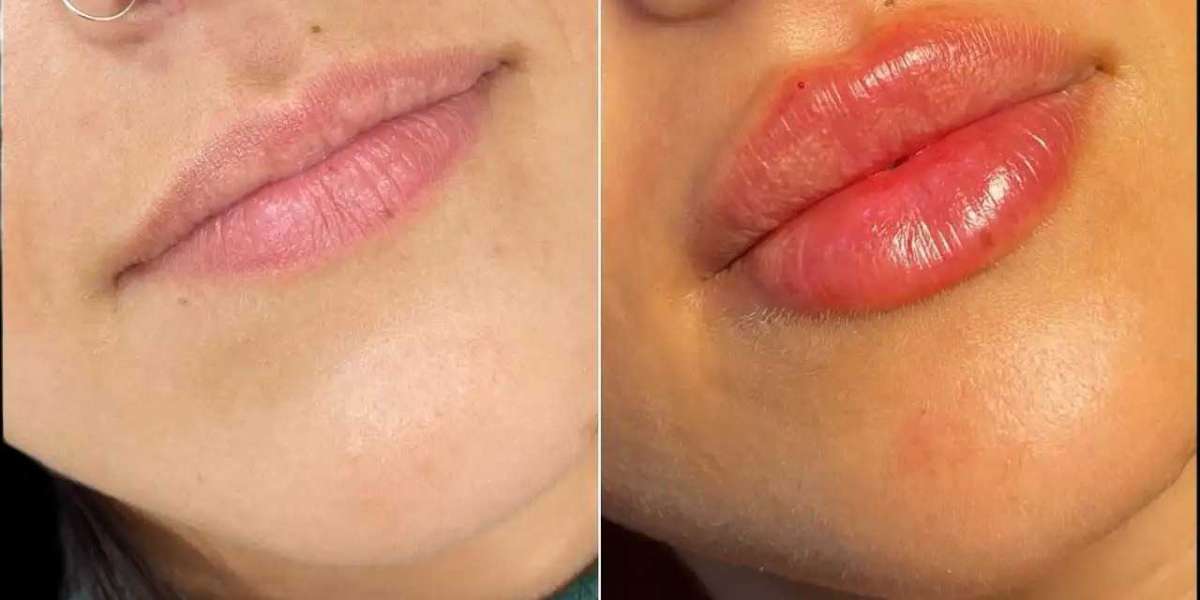 Dermal Fillers in Dubai for Natural Anti-Aging Results