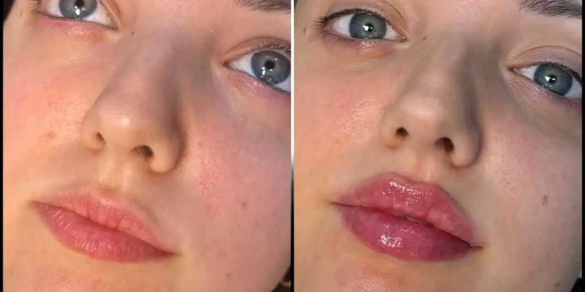 Transform Your Look with Fillers in Dubai Clinics