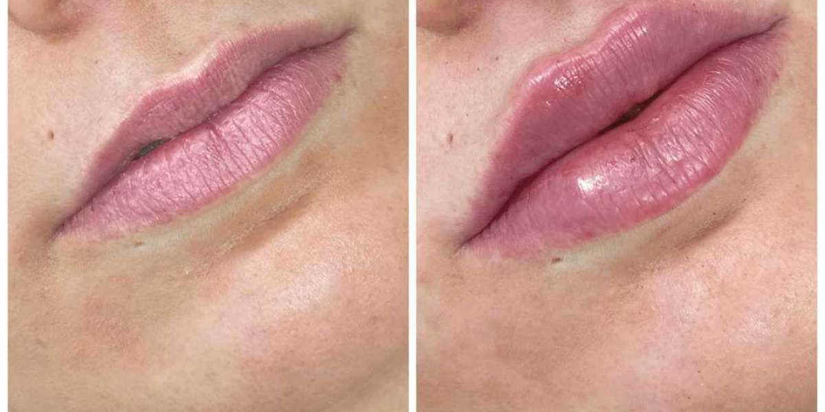How Juvederm in Dubai Helps Combat Signs of Aging