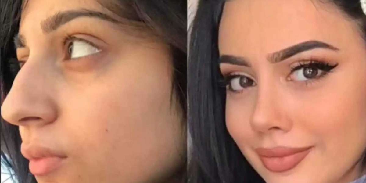 Comparing Techniques Used by the Best Rhinoplasty Surgeons in Dubai