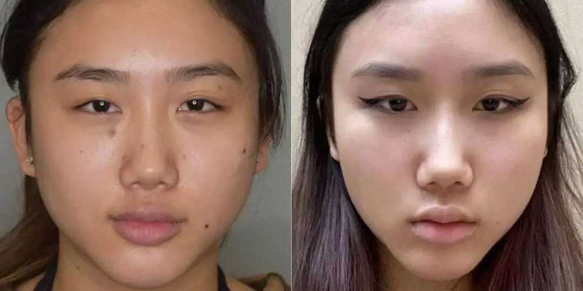 Best Buccal fat removal Surgeons in dubai provide professional expertise