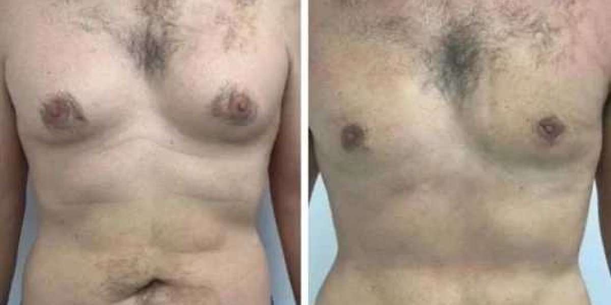 Best Gynecomastia Surgeons in Dubai: The Role of Advanced Diagnostics in Treatment Planning