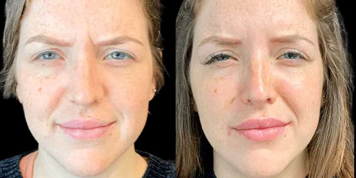 How the Best Doctors in Dubai Help Prevent Wrinkles with Botox
