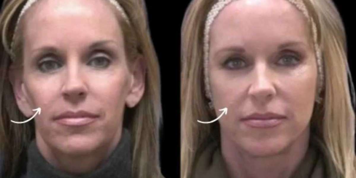 Best Aesthetic Clinic in Dubai Shares Sculptra Nutrition Tips