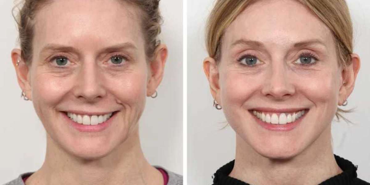 Lift Your Confidence with the Best Aesthetic Clinic in Dubai